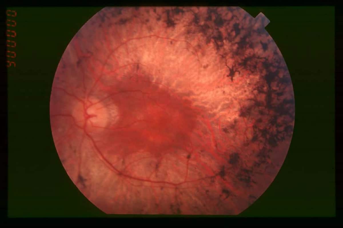 Fundus of patient with retinitis pigmentosa, mid stage (Bone spicule-shaped pigment deposits are present in the mid periphery along with retinal atrophy, while the macula is preserved although with a peripheral ring of depigmentation. Retinal vessels are attenuated.) Hamel Orphanet Journal of Rare Diseases 2006
