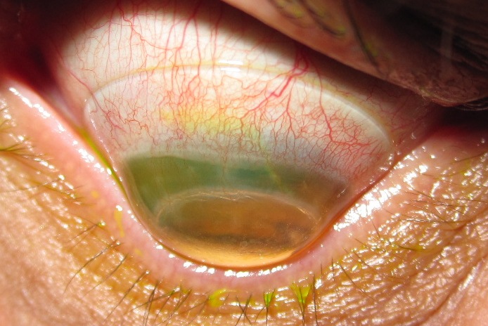 keratoconus-eye