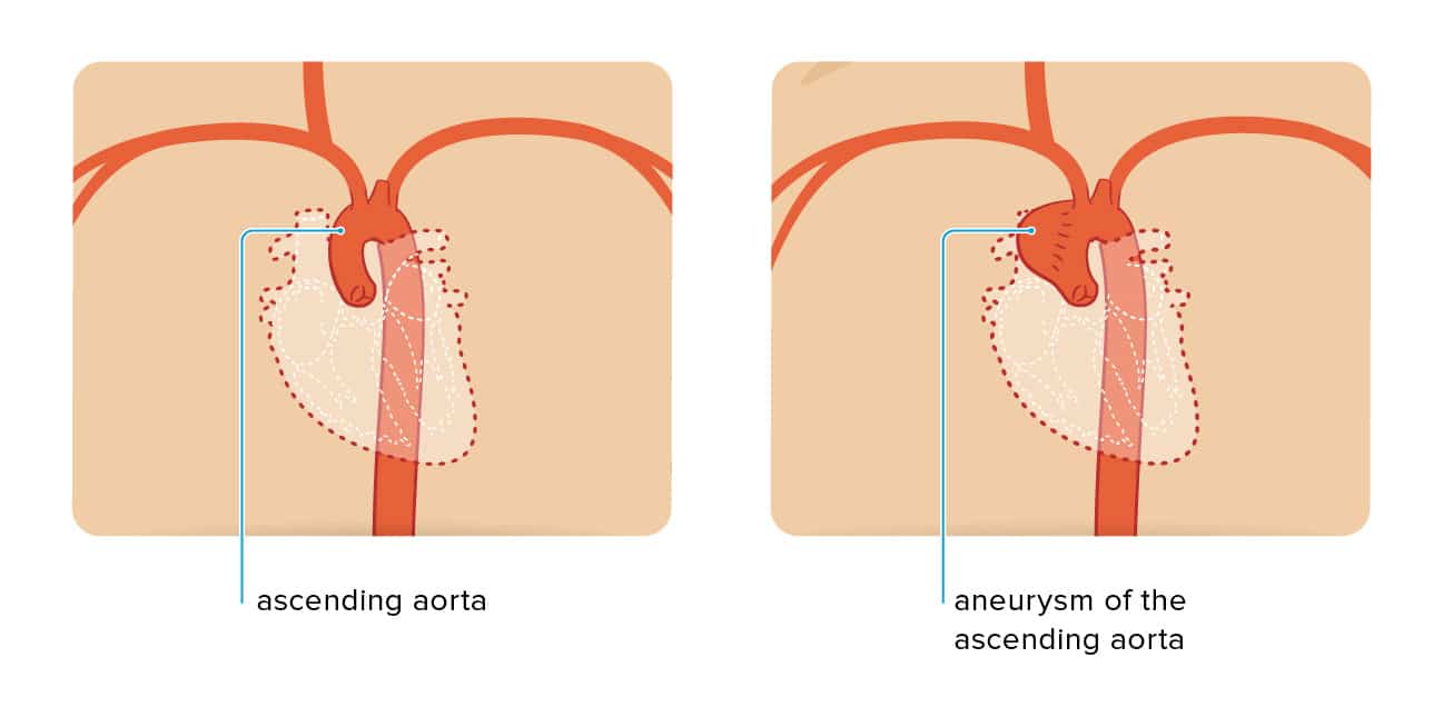 ascending aorta, normal and with aortic aneurysm
