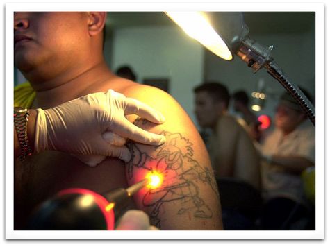 How Many Sessions Does it Take for Laser Tattoo Removal? - Rejuve Med-Spa |  Dallas, Plano